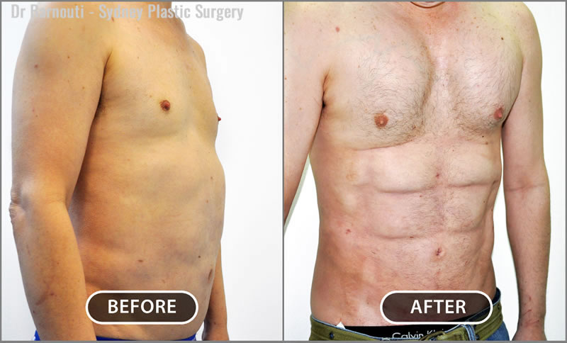 Abdominal Etching/Pectoral Implants/Liposculpture Before After Gallery