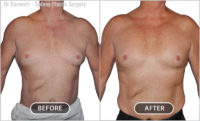This patient had a pectoral enhancement with implants.