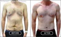 This is a patient after receiving a tummy tuck and pectoral implants.