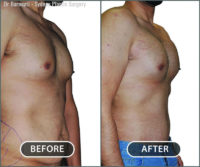 High profile pectoral implants.