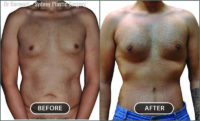 Tummy tuck and pectoral implants.