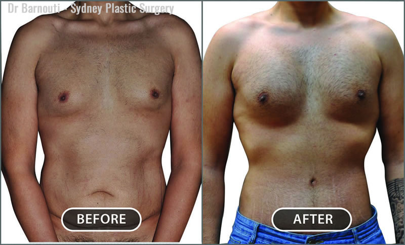 Too Much Chest: When Your Pectorals Are Too Big - Tehrani Plastic Surgery