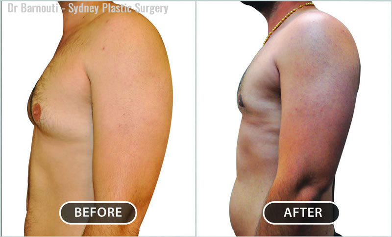 Male Breast Reduction Before / After Gallery - Sydney Plastic Surgeons