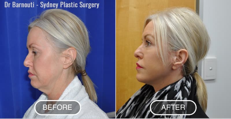 Face/Neck lift and laser treatment