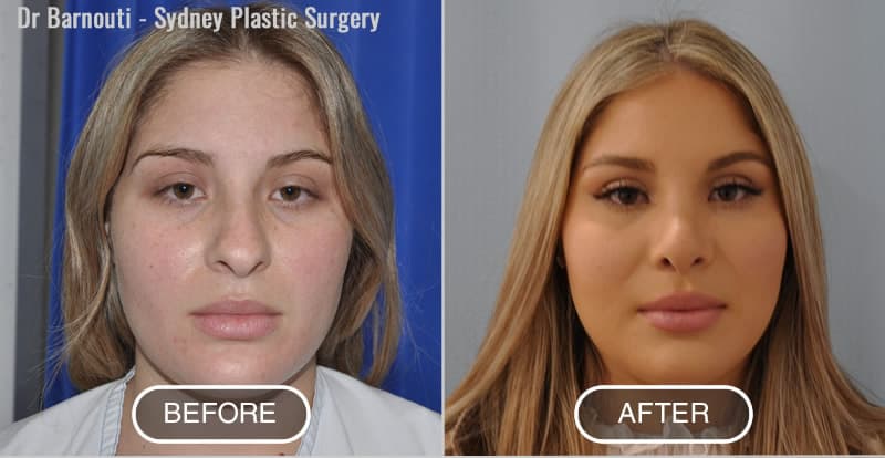 Rhinoplasty Patient