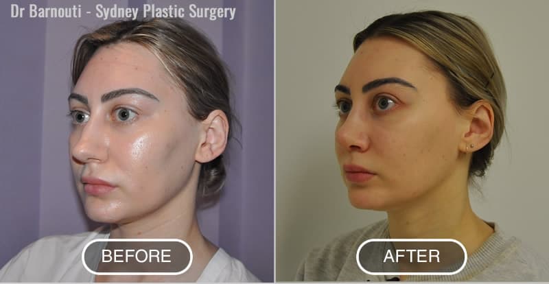 Rhinoplasty Patient