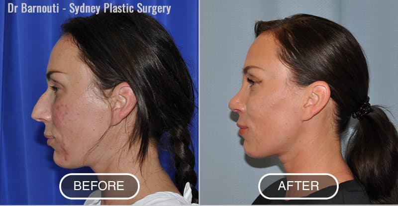 Rhinoplasty Before After