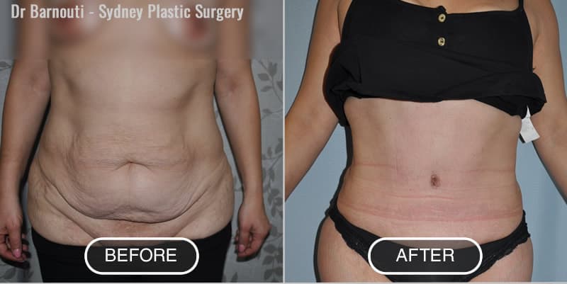 Tummy Tuck Before After