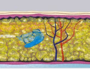 Phase 1: LipoSoft; Infiltration