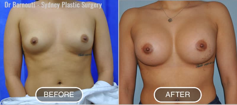 Breast Augmentation before after