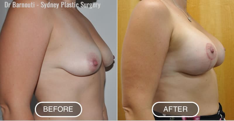 Lift and 320cc round implants