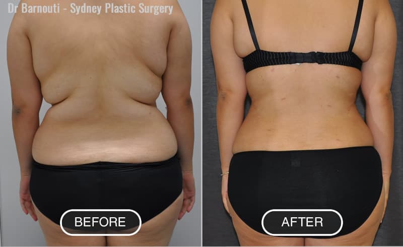 Liposuction - Before After Gallery