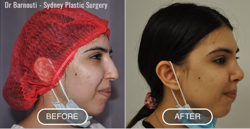 Rhinoplasty Before After