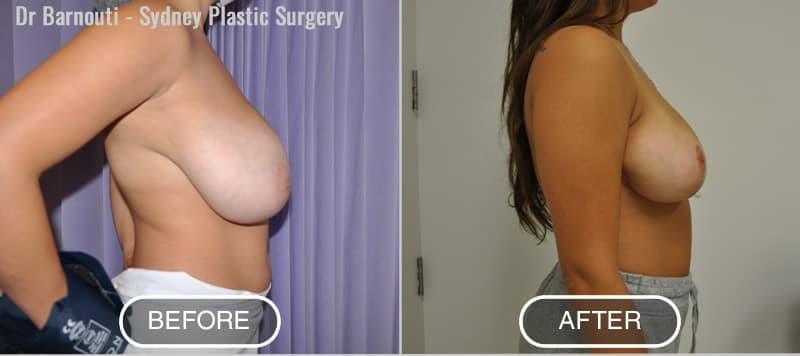 Breast Reduction - Before and After