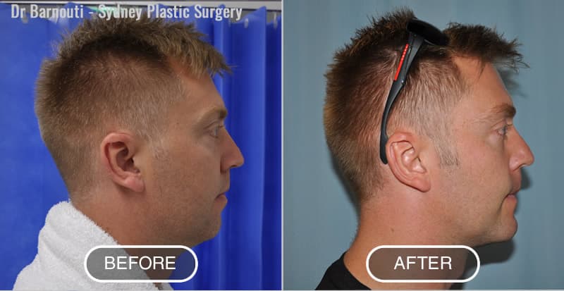 Neck Liposuction and Chin Implants Surgery