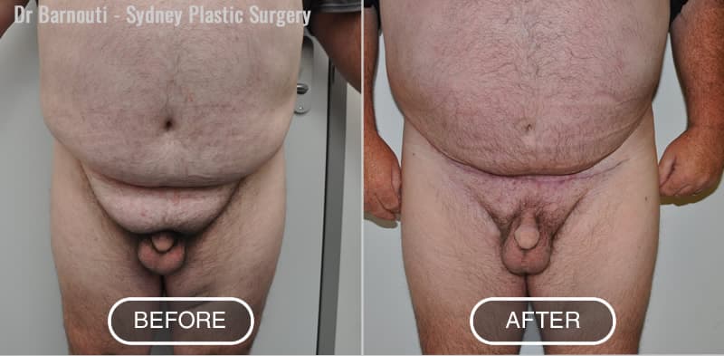 Pubic Lift and Reduction