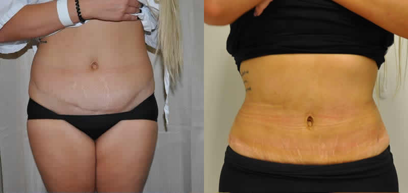 Before - Initial Surgery performed by others. After: Revision abdominoplasty and sculpture by Dr Barnouti