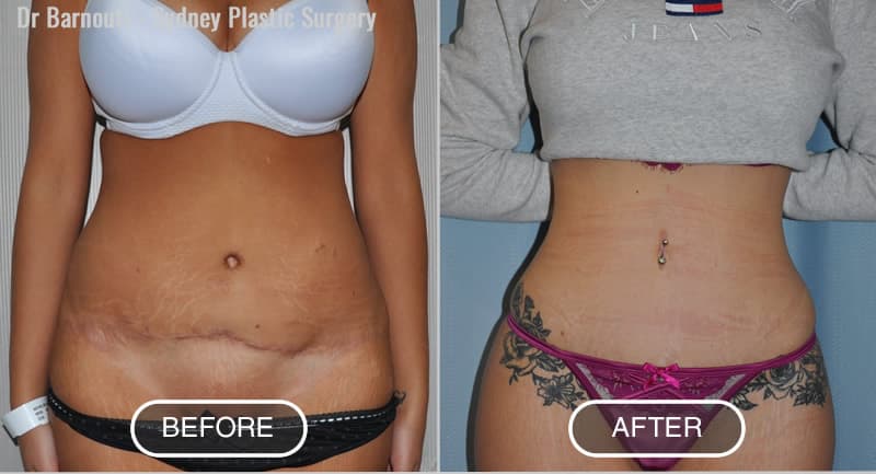 Before - Initial Surgery performed by others. After: Revision abdominoplasty and sculpture by Dr Barnouti