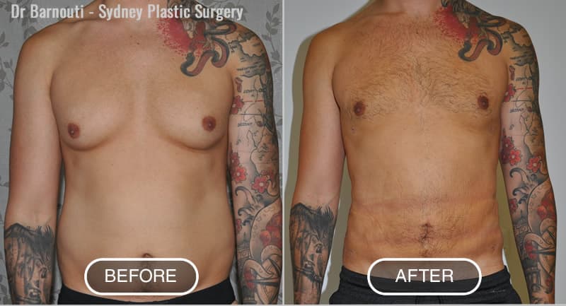 Liposuction - Abdominal Etching