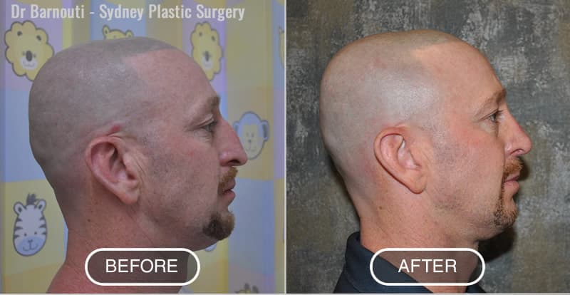 Rhinoplasty Before After Photo
