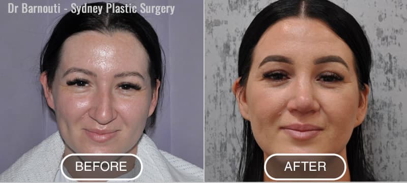 Rhinoplasty Before After Photo