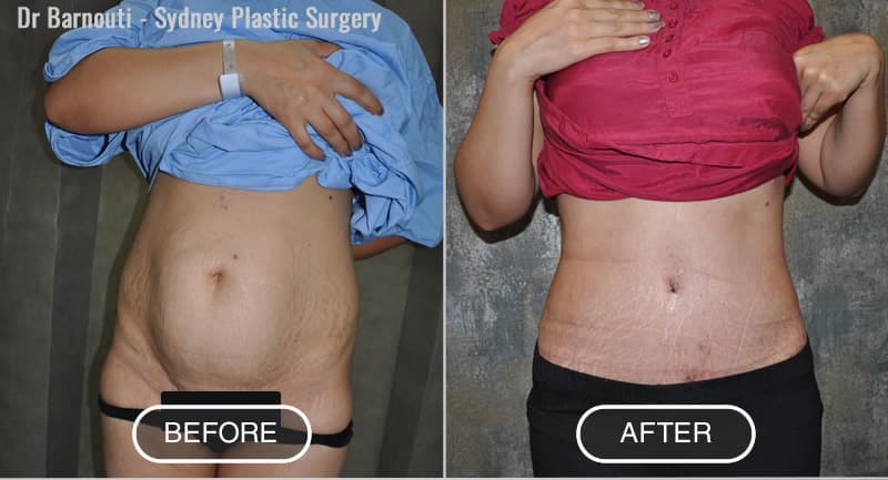 Before After Tummy Tuck