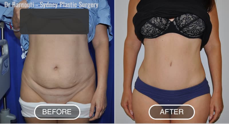 Abdominoplasty Patient Before After Photo