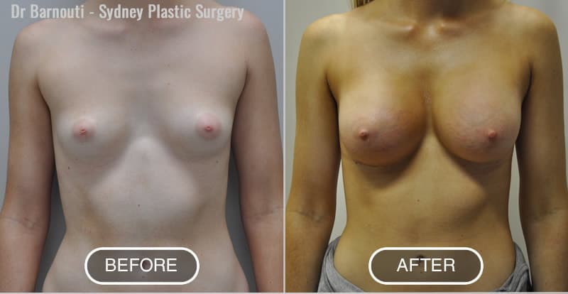 Before and after breast augmentation XHprofile 365cc by Dr Barnouti