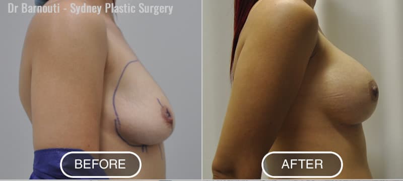 After 385cc round silicone breast implants by Dr Barnouti