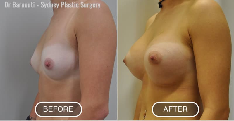 Before After Breast Surgery