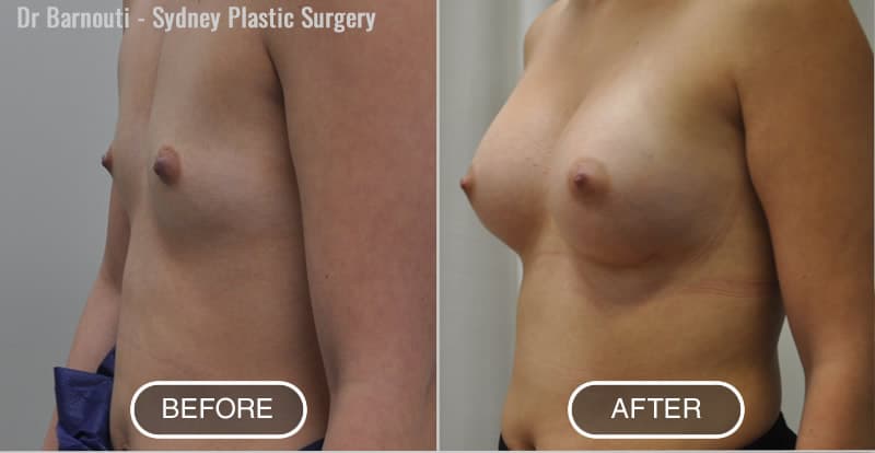 Before and after breast augmentation 320 cc Breast implants by Dr Barnouti