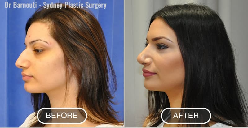 Rhinoplasty Before After