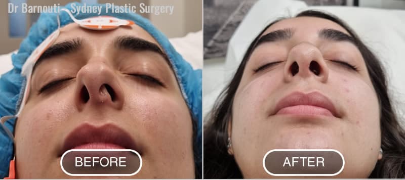 Before and After Septoplasty