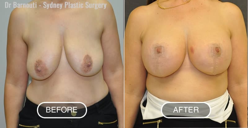 Before and after breast lift