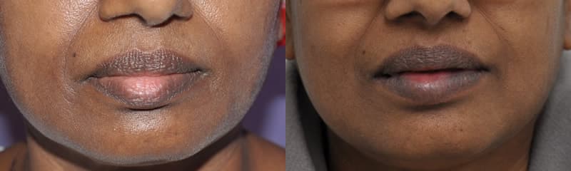 Lower Lip Reduction