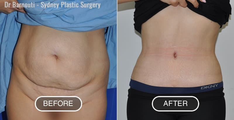 Tummy tuck before after