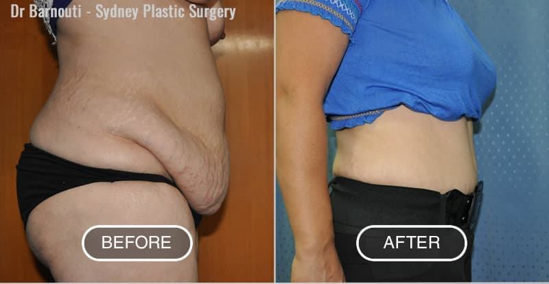 Abdominoplasty