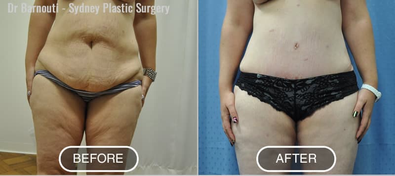 Before and after abdominoplasty, thighs lift and liposuction