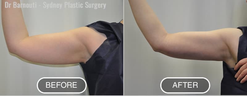 Before and after arm liposuction by Dr Barnouti