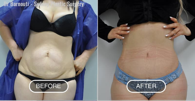 Before After Tummy Tuck