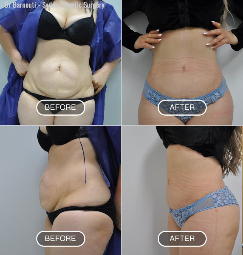 Before After Photos - Sydney Tummy Tuck By Dr Barnouti