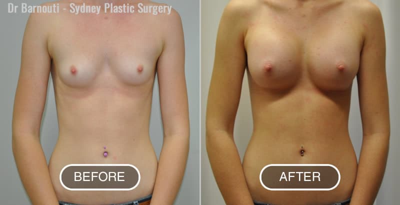 Breast Augmentation Before After