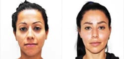 Cheek Augmentation