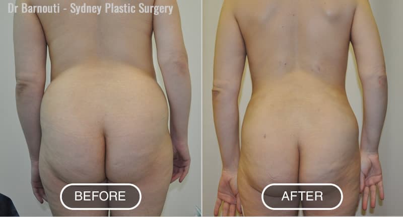 Pubic Fat Pad Removal - Mons Lift Liposuction