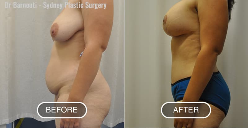 Mummy makeover, before and after breast lift and augmentation with 400cc round implants, abdominoplasty and liposculpture. Notice the new waistlines, the small belly button and the long torso.