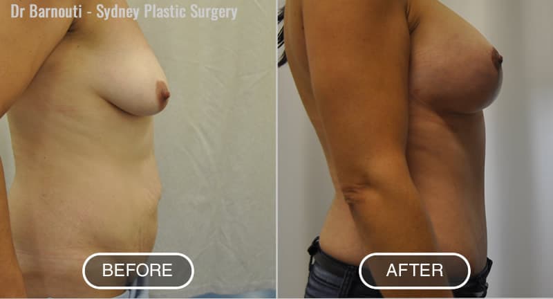 Breast lift, augmentation and abdominoplasty