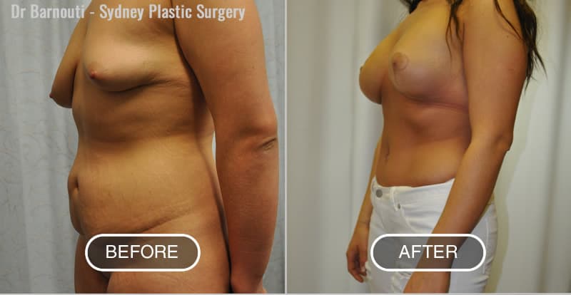 Breast lift/augmentation and abdominoplasty