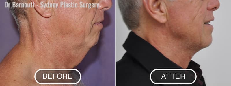 Neck lift surgery