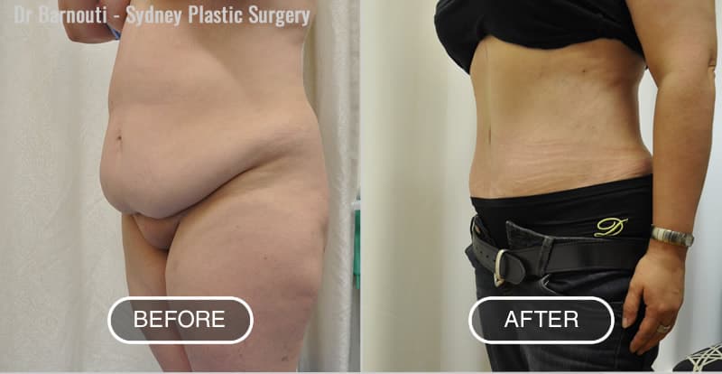 Tummy Tuck Before After