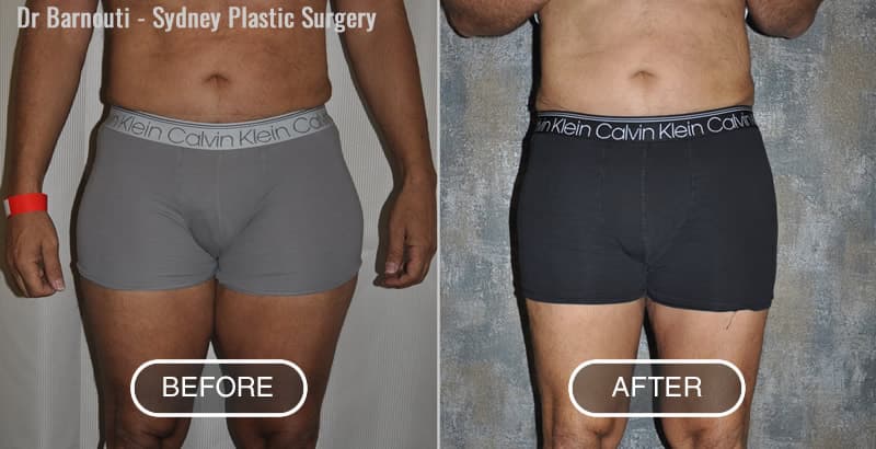 Liposuction Before After